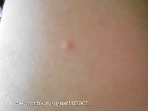 После удаления папиллом нельзя