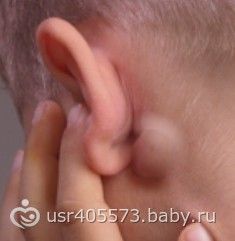 Шишка на мочке уха как лечить народными средствами Шишка на мочке уха как лечить народными средствами