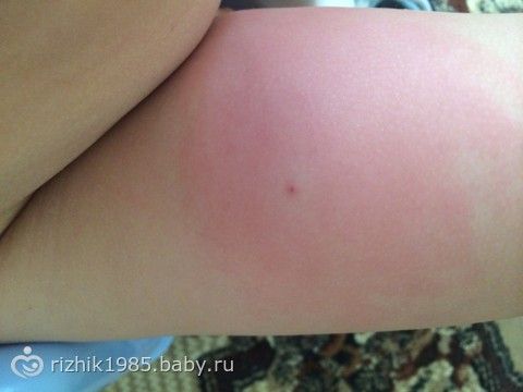Что делать с шишкой после прививки