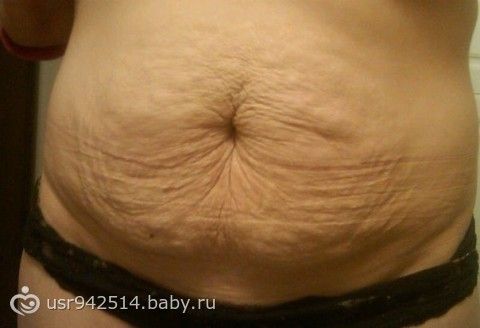 Растяжки на животе вторая беременность