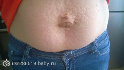 Грыжа у беременных на животе фото 32