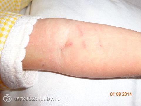Под кожей уплотнения чем лечить Под кожей уплотнения чем лечить