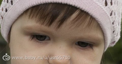 Шелушатся брови и лоб у ребенка Шелушатся брови и лоб у ребенка