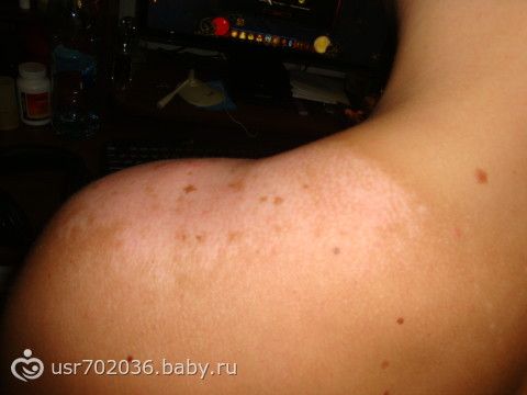 Как избавиться от ожога на солнце в домашних условиях 285