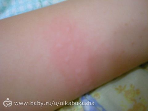 Сыпь похожая на укус насекомого у ребенка Сыпь похожая на укус насекомого у ребенка