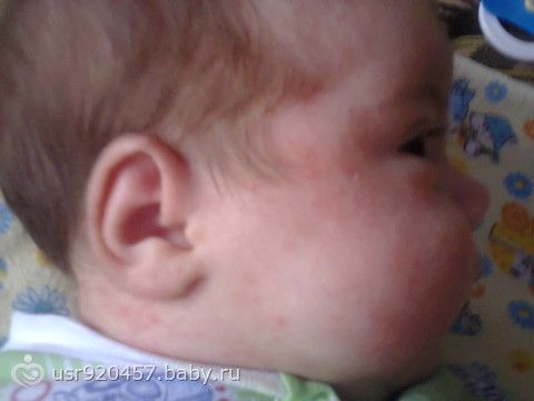Сыпь у ребёнка на голове и лице Сыпь у ребёнка на голове и лице