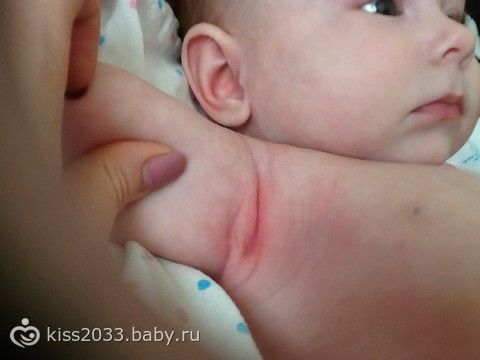 Если у грудничка красные складки Если у грудничка красные складки