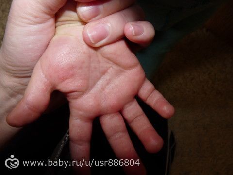 На ладонях появились подкожные прыщи что это На ладонях появились подкожные прыщи что это