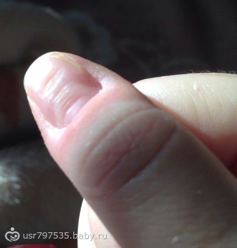 Что делать если отпадают ногти на руках Что делать если отпадают ногти на руках