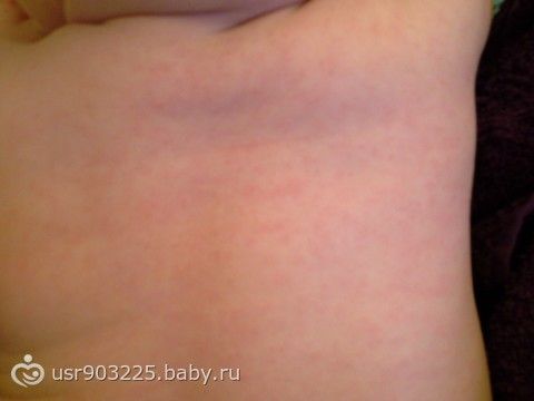 Ребенок три дня температура потом сыпь Ребенок три дня температура потом сыпь
