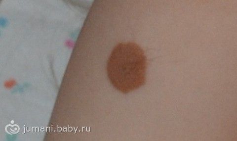 Удаление папиллом ляписным карандашом
