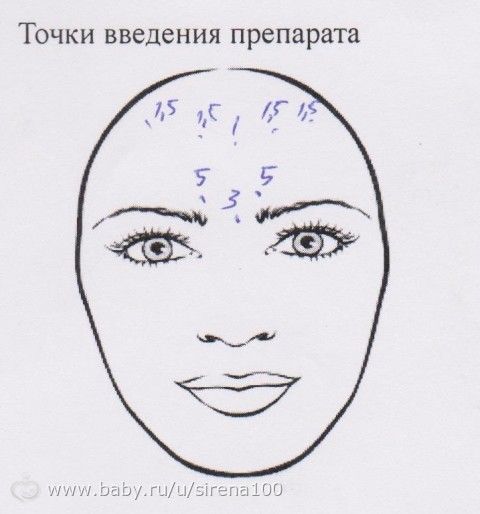 Ботокс (до и после)