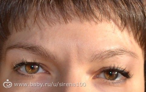 Ботокс (до и после)