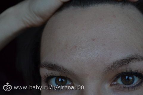Ботокс (до и после)