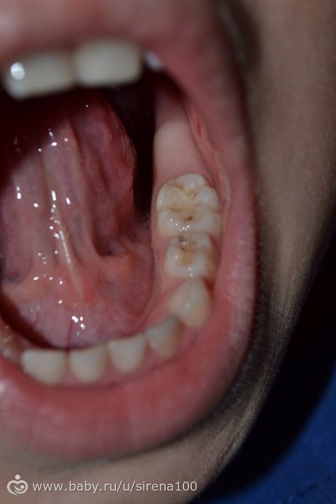 Лечение кариеса (фото зубов)