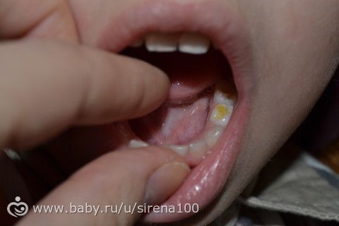 Лечение кариеса (фото зубов)