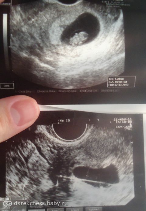Фото узи беременности 4 недели от момента зачатия