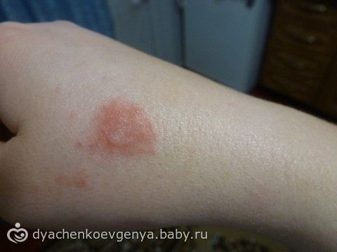 Что еще похоже на псориаз