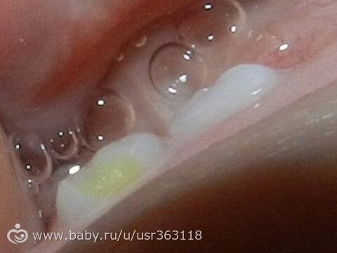 Реминерализация зубов - Tooth Mousse (тус мус) или R.O.C.S. (рокс)?