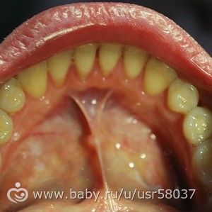 Пластика уздечки языка и показания к френуллопластике