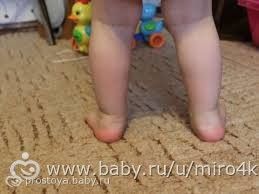 Вальгусные стопы у ребенка!!! Кто сталкивался?