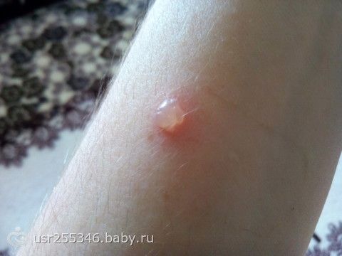 На руке у ребенка появилось красное пятно как ожог фото На руке у ребенка появилось красное пятно как ожог фото