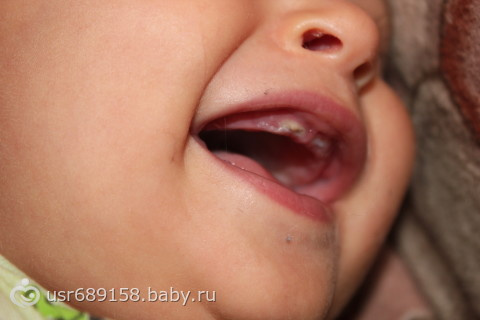 Белые точки на десне у годовалого ребенка..