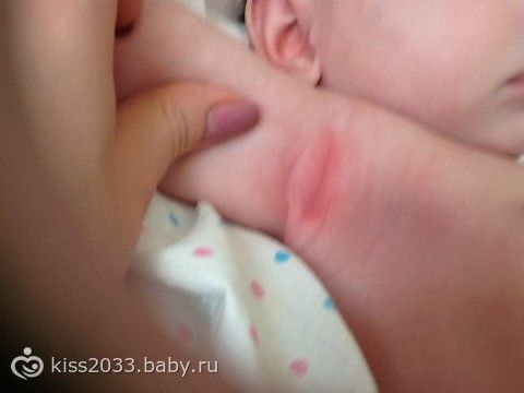 Опрелости у ребенка под мышками фото Опрелости у ребенка под мышками фото