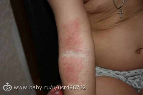 сыпь!!!!!!! девочки посмотрите у кого было такое??? что это???? чем лечили???? сколько прозодило???