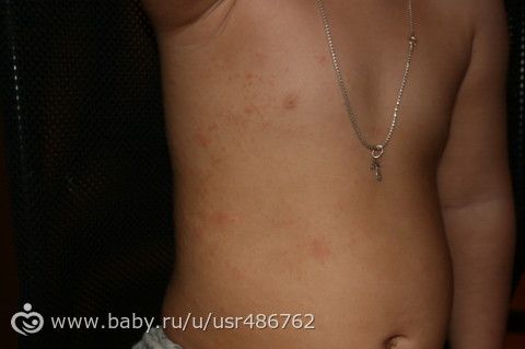 сыпь!!!!!!! девочки посмотрите у кого было такое??? что это???? чем лечили???? сколько прозодило???