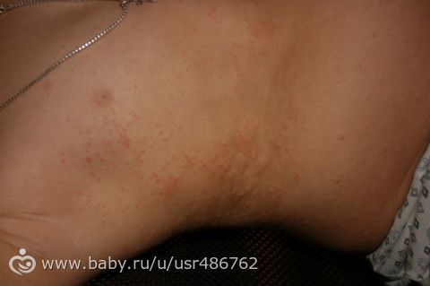 сыпь!!!!!!! девочки посмотрите у кого было такое??? что это???? чем лечили???? сколько прозодило???