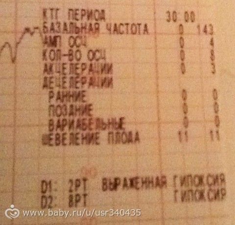 Сходила на первое КТГ- рыдаю(((