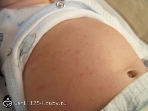 На руках появились мелкие пупырышки и чешутся На руках появились мелкие пупырышки и чешутся