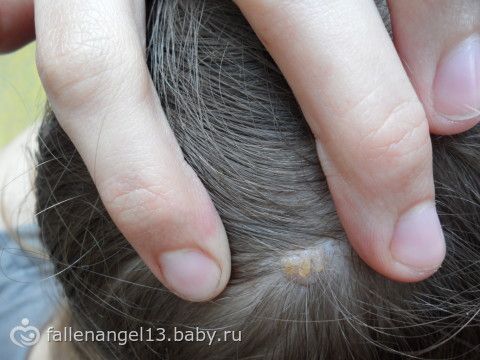 Из за чего появляются папилломы на теле у женщин