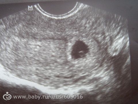 5 недель не слышно сердцебиения